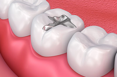 The image shows a close-up of a human dental implant with a screw in place, set within a tooth-like structure that resembles a natural tooth surrounded by gum tissue against a pink background.