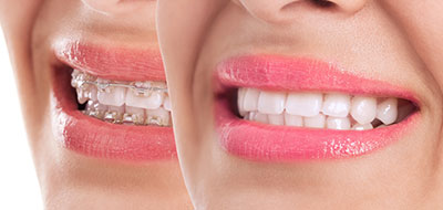 The image shows a woman with a smile displaying her teeth, captured from two different angles.