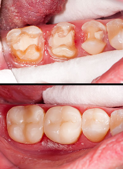 The image shows a close-up view of a person s mouth with teeth that appear to be in poor condition, possibly due to decay or gum disease, and the teeth are being worked on by a dental professional, as indicated by the presence of dental instruments and a dental dam.