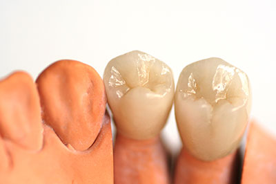 The image displays two dental implants with crowns, one showing a tooth-like structure and the other a gum-like material, set against a white background.