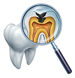 An illustration depicts an open tooth with a magnifying glass positioned over it, revealing internal dental structures such as pulp, root canals, and nerve endings, with an emphasis on the pulp area where a small black object resembles a whale s fin, symbolizing decay or infection.