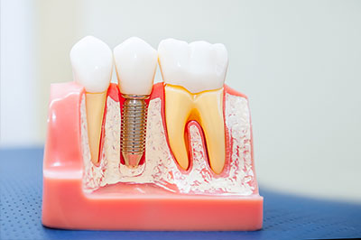 The image shows a model of a human mouth with a focus on dental implants, featuring a tooth with an exposed screw at the base, surrounded by other teeth and gum-like material, set against a pink background that resembles a jawbone.