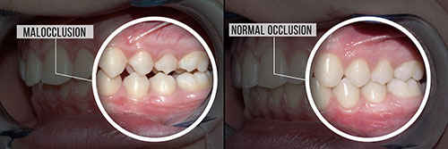 The image shows two side-by-side photographs of a dental implant procedure with annotations indicating  Normal occlusion  and  Malocclusion.