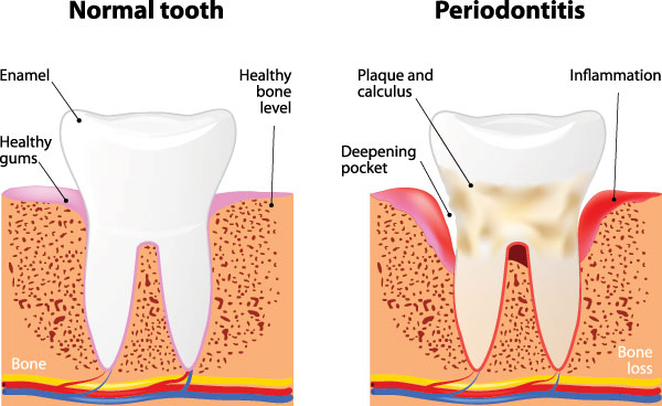 The image shows a diagrammatic representation of the stages of tooth decay, from normal to severe, with labels indicating each stage s condition and the corresponding dental structure affected.