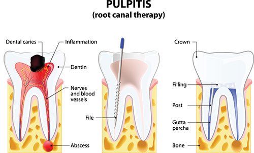 The image displays a diagrammatic representation of a dental procedure, specifically focusing on pulpitis with an illustration of a tooth being treated for infection, showing a root canal therapy process with labeled parts such as dental caries, inflammation, and tools like drills and files used in the procedure.