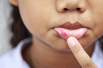 A young child with their hand touching their lips, showing a visible red rash on their skin.