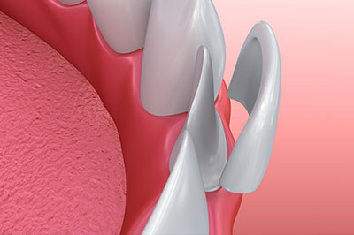 The image shows a close-up view of a dental implant with a metal abutment protruding from the top of a pink gum, set against a medical background.