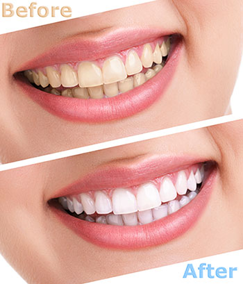 The image shows a before-and-after comparison of dental treatments, featuring a person s smile with noticeable teeth whitening after treatment.